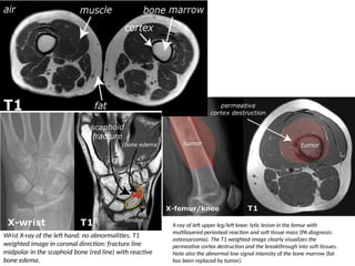 Navicular Cortex Mri MRI physics WITH GOOD EXPLAINATION .pptx
