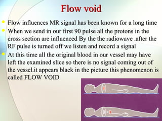 Flow voidFlow void
 Flow influences MR signal has been known for a long timeFlow influences MR signal has been known for a long time
 When we send in our first 90 pulse all the protons in theWhen we send in our first 90 pulse all the protons in the
cross section are influenced By the the radiowave .after thecross section are influenced By the the radiowave .after the
RF pulse is turned off we listen and record a signalRF pulse is turned off we listen and record a signal
 At this time all the original blood in our vessel may haveAt this time all the original blood in our vessel may have
left the examined slice so there is no signal coming out ofleft the examined slice so there is no signal coming out of
the vessel.it appears black in the picture this phenomenon isthe vessel.it appears black in the picture this phenomenon is
called FLOW VOIDcalled FLOW VOID
 