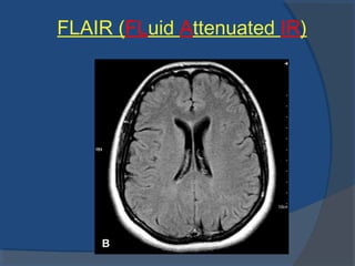 FLAIR (FLuid Attenuated IR)
 