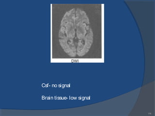 176
Csf- no signal
Brain tissue- low signal
 