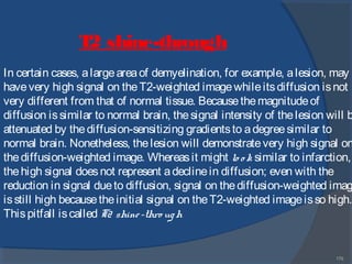 179
In certain cases, alargeareaof demyelination, for example, alesion, may
havevery high signal on theT2-weighted imagewhileitsdiffusion isnot
very different from that of normal tissue. Becausethemagnitudeof
diffusion issimilar to normal brain, thesignal intensity of thelesion will b
attenuated by thediffusion-sensitizing gradientsto adegreesimilar to
normal brain. Nonetheless, thelesion will demonstratevery high signal on
thediffusion-weighted image. Whereasit might lo o k similar to infarction,
thehigh signal doesnot represent adeclinein diffusion; even with the
reduction in signal dueto diffusion, signal on thediffusion-weighted imag
isstill high becausetheinitial signal on theT2-weighted imageisso high.
Thispitfall iscalled T2 shine-thro ugh
T2 shine-through
 