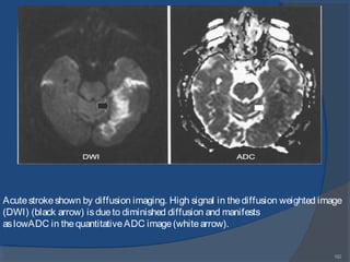 182
Acutestrokeshown by diffusion imaging. High signal in thediffusion weighted image
(DWI) (black arrow) isdueto diminished diffusion and manifests
aslowADC in thequantitativeADC image(whitearrow).
 