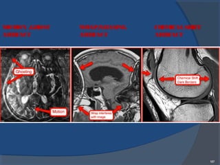 187
MOTION /GHOST
ARTIFACT
WRAP/ALIASING
ARTIFACT
CHEMICALSHIFT
ARTIFACT
 