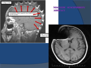 192
MAGNETIC SUSCEPTIBILITY
ARTIFACT
 