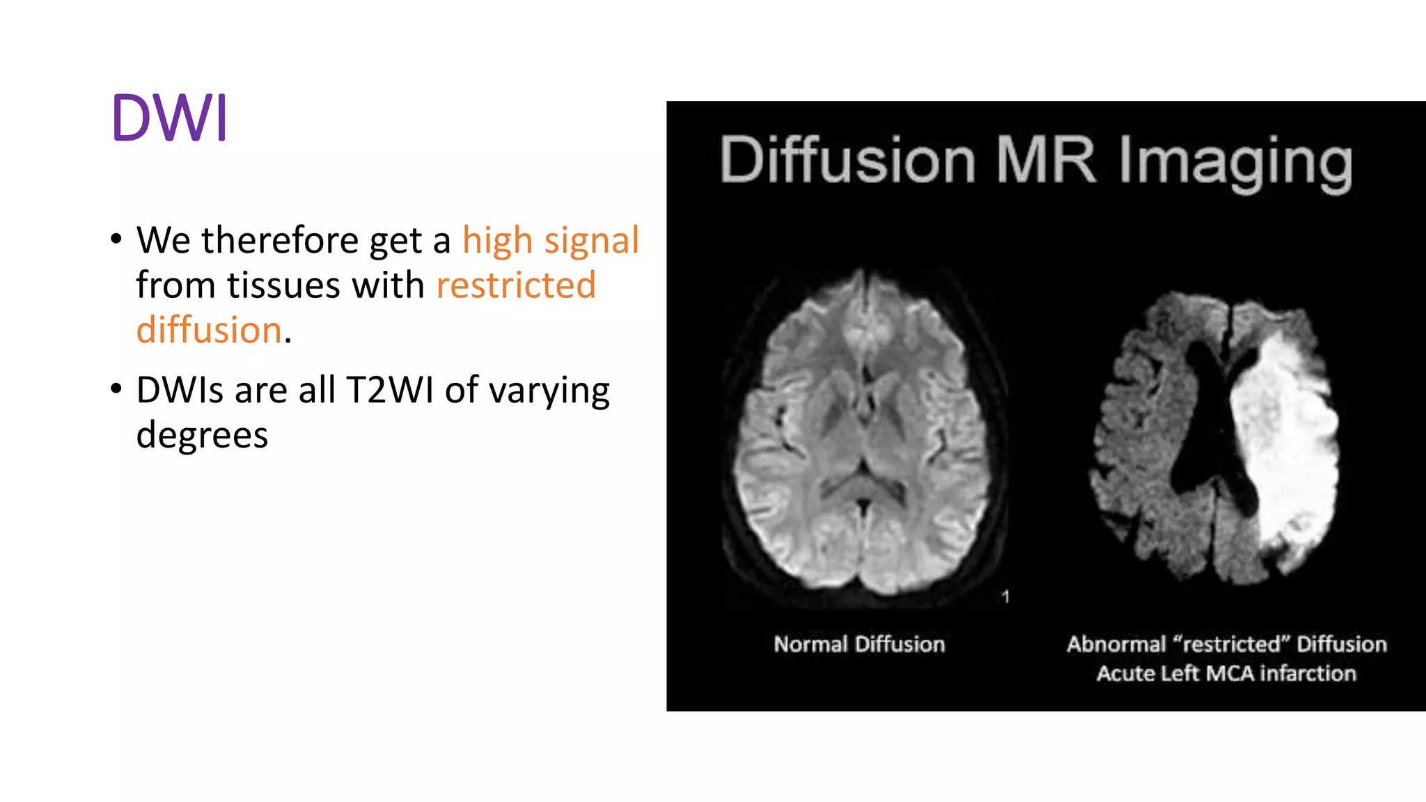 DWI
• We therefore get a high signal
from tissues with restricted
diffusion.
• DWIs are all T2WI of varying
degrees
 
