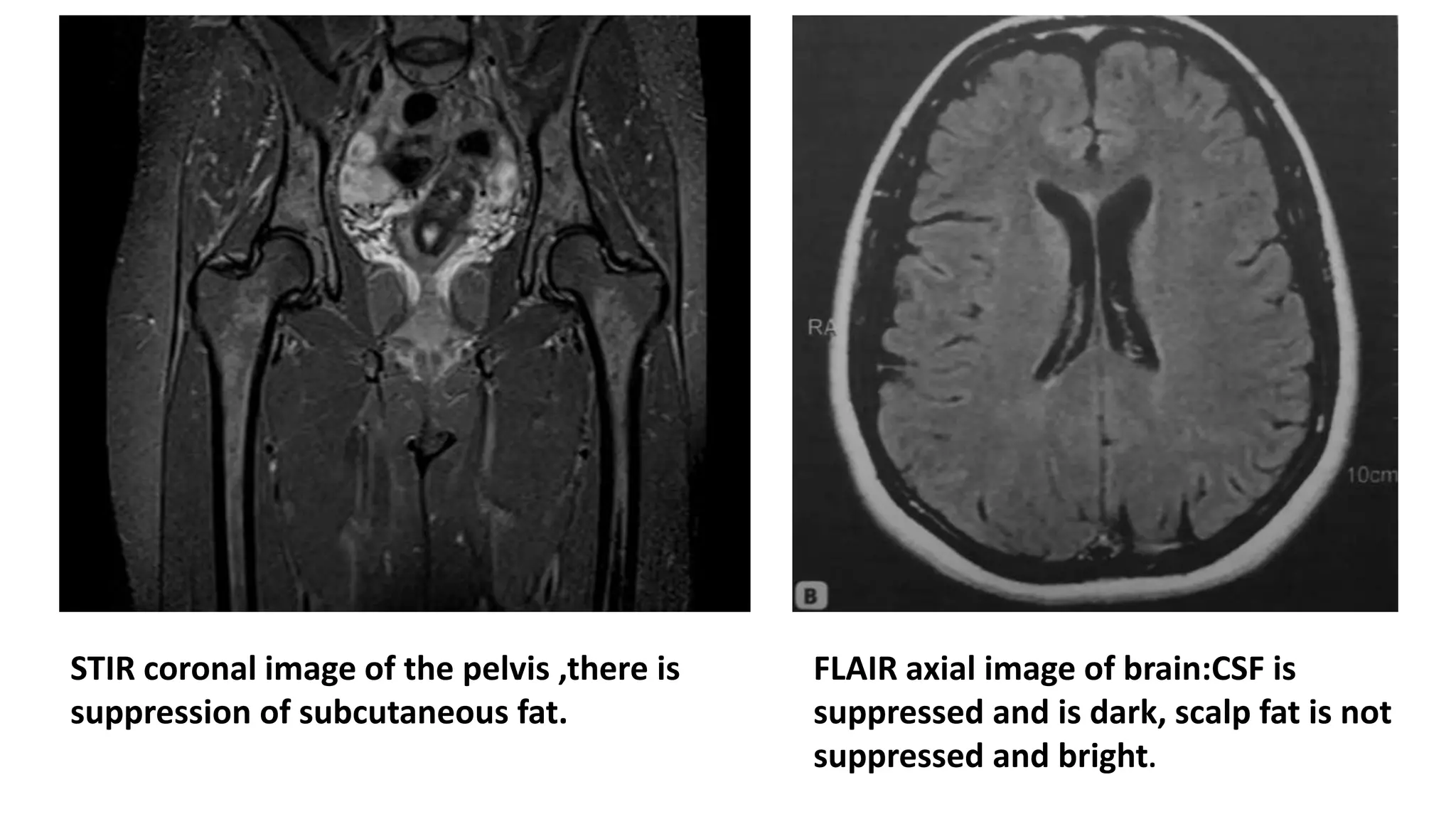 STIR coronal image of the pelvis ,there is
suppression of subcutaneous fat.
FLAIR axial image of brain:CSF is
suppressed and is dark, scalp fat is not
suppressed and bright.
 