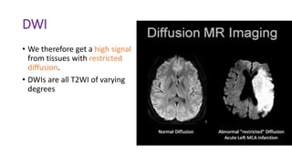 DWI
• We therefore get a high signal
from tissues with restricted
diffusion.
• DWIs are all T2WI of varying
degrees
 