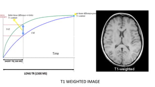 T1 WEIGHTED IMAGE
 