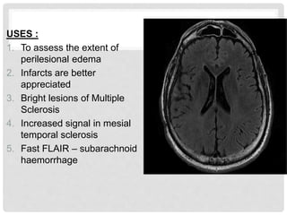 USES :
1. To assess the extent of
perilesional edema
2. Infarcts are better
appreciated
3. Bright lesions of Multiple
Sclerosis
4. Increased signal in mesial
temporal sclerosis
5. Fast FLAIR – subarachnoid
haemorrhage
 