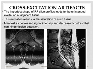 CROSS-EXCITATION ARTIFACTS
• The imperfect shape of RF slice profiles leads to the unintended
excitation of adjacent tissue.
• This excitation results in the saturation of such tissue
• Manifest as decreased signal intensity and decreased contrast that
can hinder lesion detection.
2/25/2016 48MRI artifacts-sudil
 