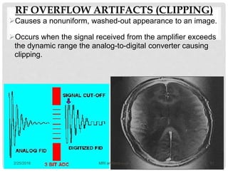 RF OVERFLOW ARTIFACTS (CLIPPING)
Causes a nonuniform, washed-out appearance to an image.
Occurs when the signal received from the amplifier exceeds
the dynamic range the analog-to-digital converter causing
clipping.
2/25/2016 51MRI artifacts-sudil
 