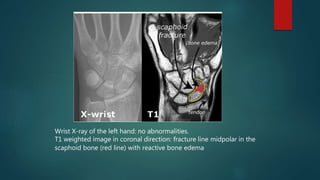 Wrist X-ray of the left hand: no abnormalities.
T1 weighted image in coronal direction: fracture line midpolar in the
scaphoid bone (red line) with reactive bone edema.
 