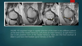 FIGURE: PD weighted image in sagittal direction of the knee in two different patients
(at the level of the medial meniscus). Left shows an intact meniscus, at right there is a
tear in the posterior horn of the medial meniscus. Note also that fluid (hydrops &
Baker’s cyst) have intermediate signal intensity on the PD.
 