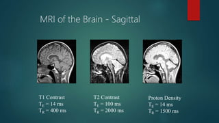 MRI of the Brain - Sagittal
T1 Contrast
TE = 14 ms
TR = 400 ms
T2 Contrast
TE = 100 ms
TR = 2000 ms
Proton Density
TE = 14 ms
TR = 1500 ms
 