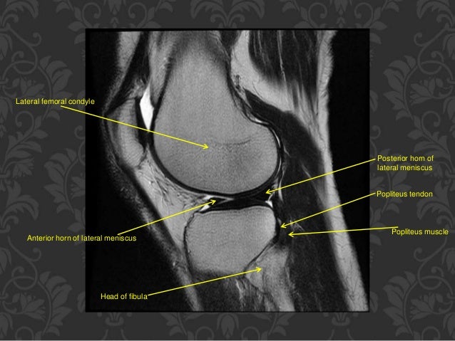 MRI KNEE OF ORTHOPEDIC IMPORTANCE