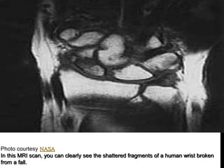 Photo courtesy NASA
In this MRI scan, you can clearly see the shattered fragments of a human wrist broken
from a fall.
 