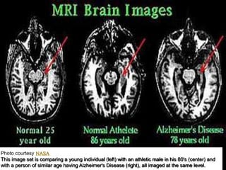 Photo courtesy NASA
This image set is comparing a young individual (left) with an athletic male in his 80's (center) and
with a person of similar age having Alzheimer's Disease (right), all imaged at the same level.
 