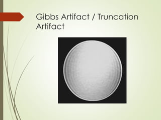 Gibbs Artifact / Truncation
Artifact
 