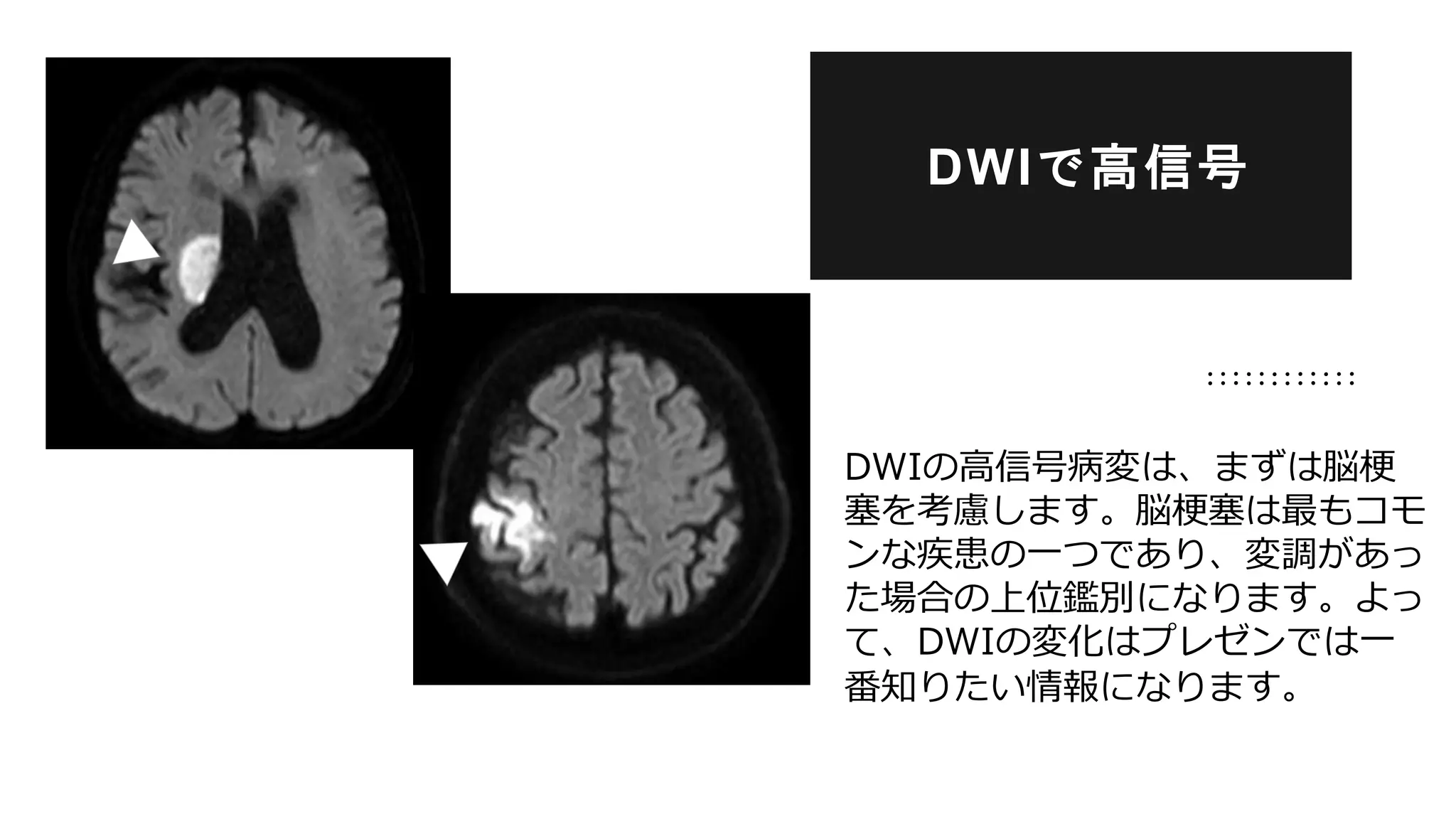 DWIの高信号病変は、まずは脳梗
塞を考慮します。脳梗塞は最もコモ
ンな疾患の一つであり、変調があっ
た場合の上位鑑別になります。よっ
て、DWIの変化はプレゼンでは一
番知りたい情報になります。
DWIで高信号
 