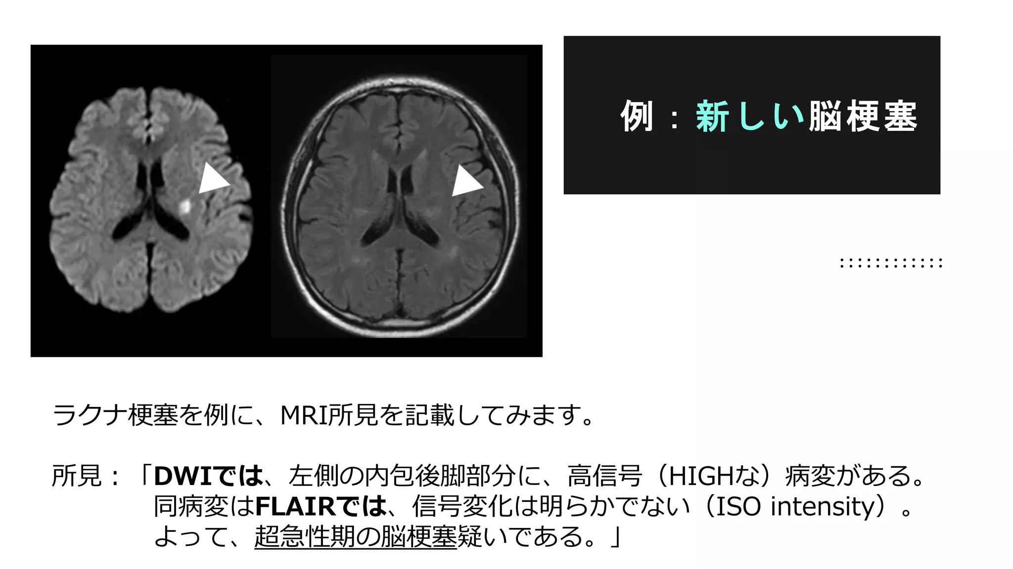 ラクナ梗塞を例に、MRI所見を記載してみます。
所見：「DWIでは、左側の内包後脚部分に、高信号（HIGHな）病変がある。
同病変はFLAIRでは、信号変化は明らかでない（ISO intensity）。
よって、超急性期の脳梗塞疑いである。」
例：新しい脳梗塞
 