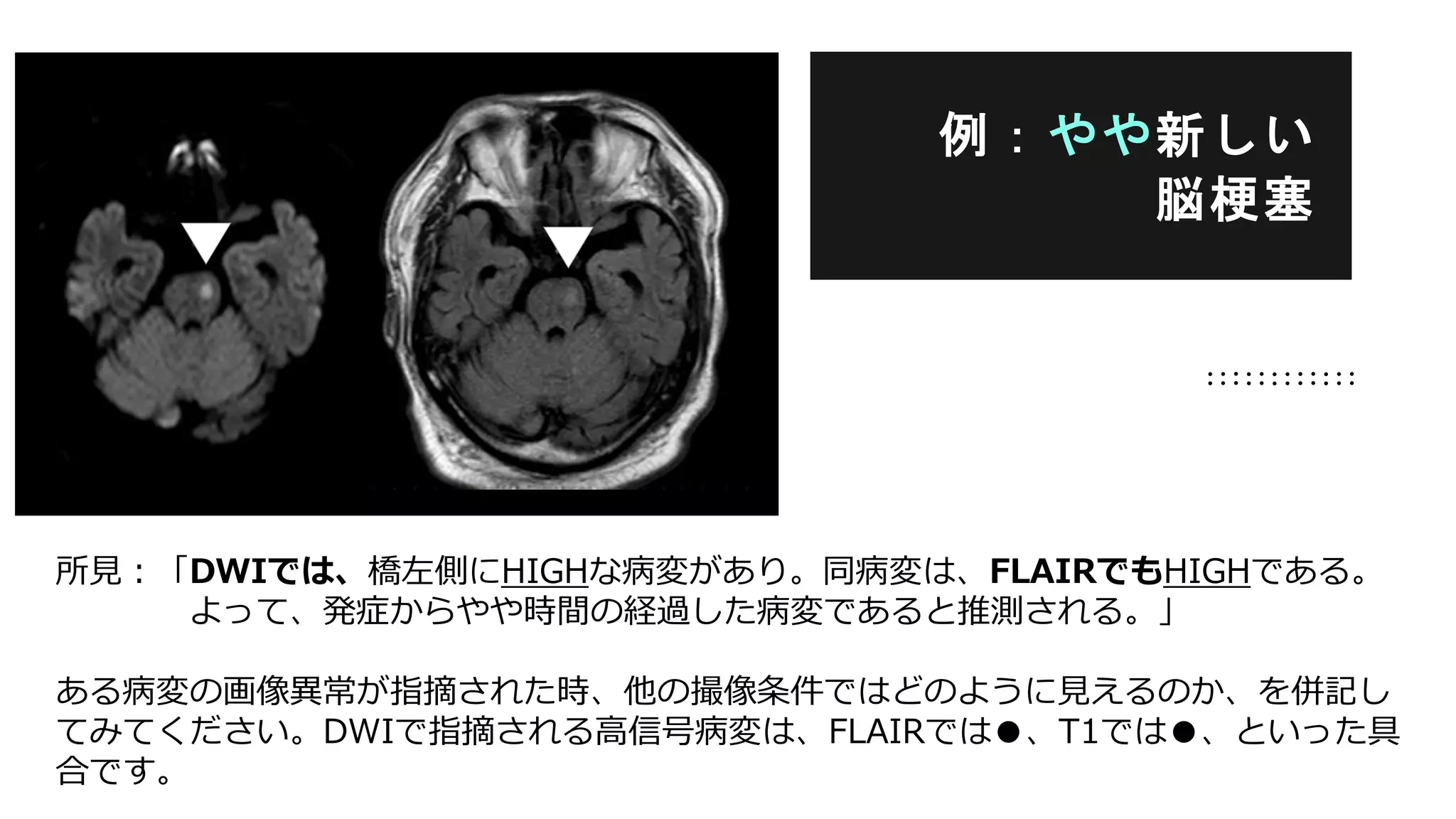 所見：「DWIでは、橋左側にHIGHな病変があり。同病変は、FLAIRでもHIGHである。
よって、発症からやや時間の経過した病変であると推測される。」
ある病変の画像異常が指摘された時、他の撮像条件ではどのように見えるのか、を併記し
てみてください。DWIで指摘される高信号病変は、FLAIRでは●、T1では●、といった具
合です。
例：やや新しい
脳梗塞
 