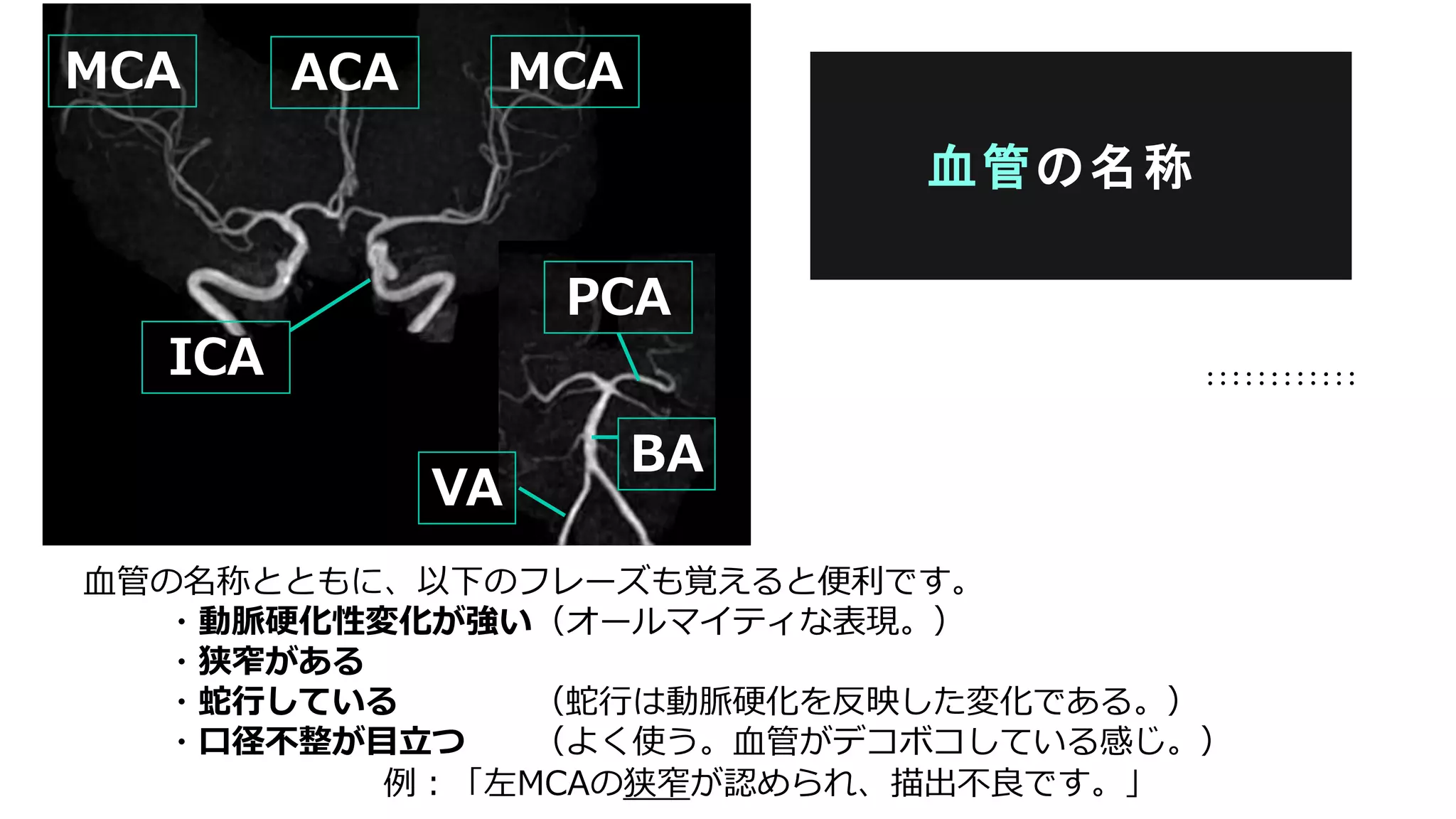 血管の名称とともに、以下のフレーズも覚えると便利です。
・動脈硬化性変化が強い（オールマイティな表現。）
・狭窄がある
・蛇行している （蛇行は動脈硬化を反映した変化である。）
・口径不整が目立つ （よく使う。血管がデコボコしている感じ。）
例：「左MCAの狭窄が認められ、描出不良です。」
血管の名称
MCA ACA MCA
ICA
VA
BA
PCA
 