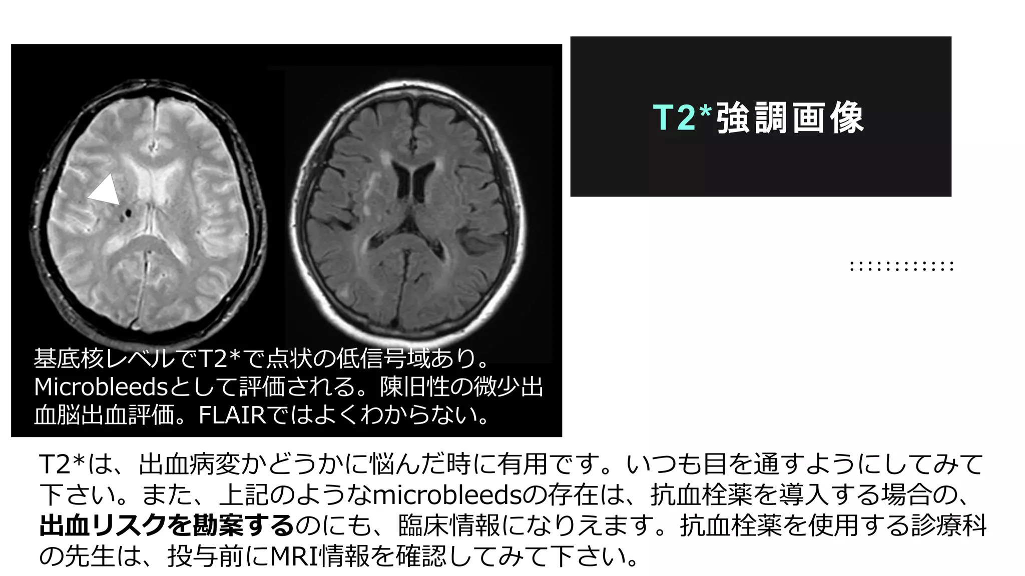 T2*は、出血病変かどうかに悩んだ時に有用です。いつも目を通すようにしてみて
下さい。また、上記のようなmicrobleedsの存在は、抗血栓薬を導入する場合の、
出血リスクを勘案するのにも、臨床情報になりえます。抗血栓薬を使用する診療科
の先生は、投与前にMRI情報を確認してみて下さい。
T2*強調画像
基底核レベルでT2*で点状の低信号域あり。
Microbleedsとして評価される。陳旧性の微少出
血脳出血評価。FLAIRではよくわからない。
 