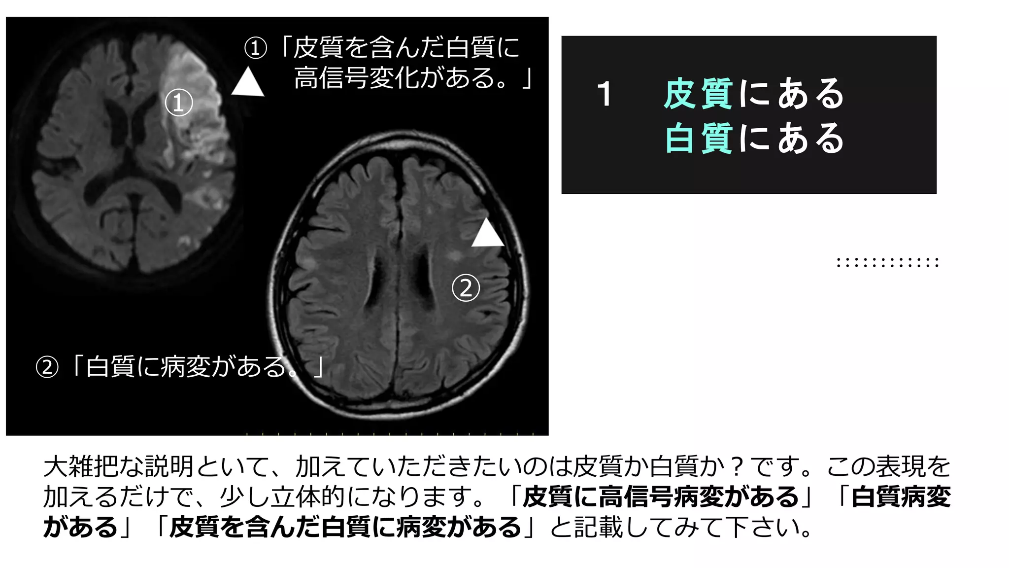 大雑把な説明といて、加えていただきたいのは皮質か白質か？です。この表現を
加えるだけで、少し立体的になります。「皮質に高信号病変がある」「白質病変
がある」「皮質を含んだ白質に病変がある」と記載してみて下さい。
１ 皮質にある
白質にある
①「皮質を含んだ白質に
高信号変化がある。」
②「白質に病変がある。」
①
②
 