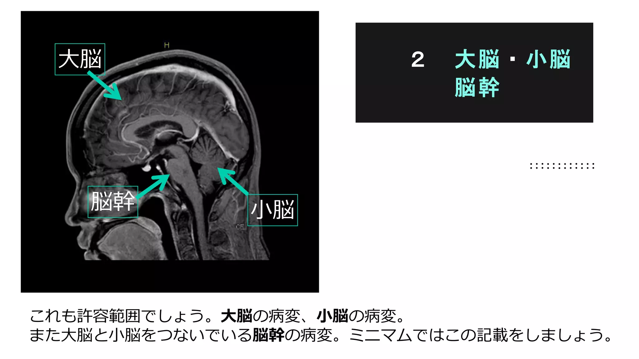 これも許容範囲でしょう。大脳の病変、小脳の病変。
また大脳と小脳をつないでいる脳幹の病変。ミニマムではこの記載をしましょう。
２ 大脳・小脳
脳幹
大脳
小脳脳幹
 