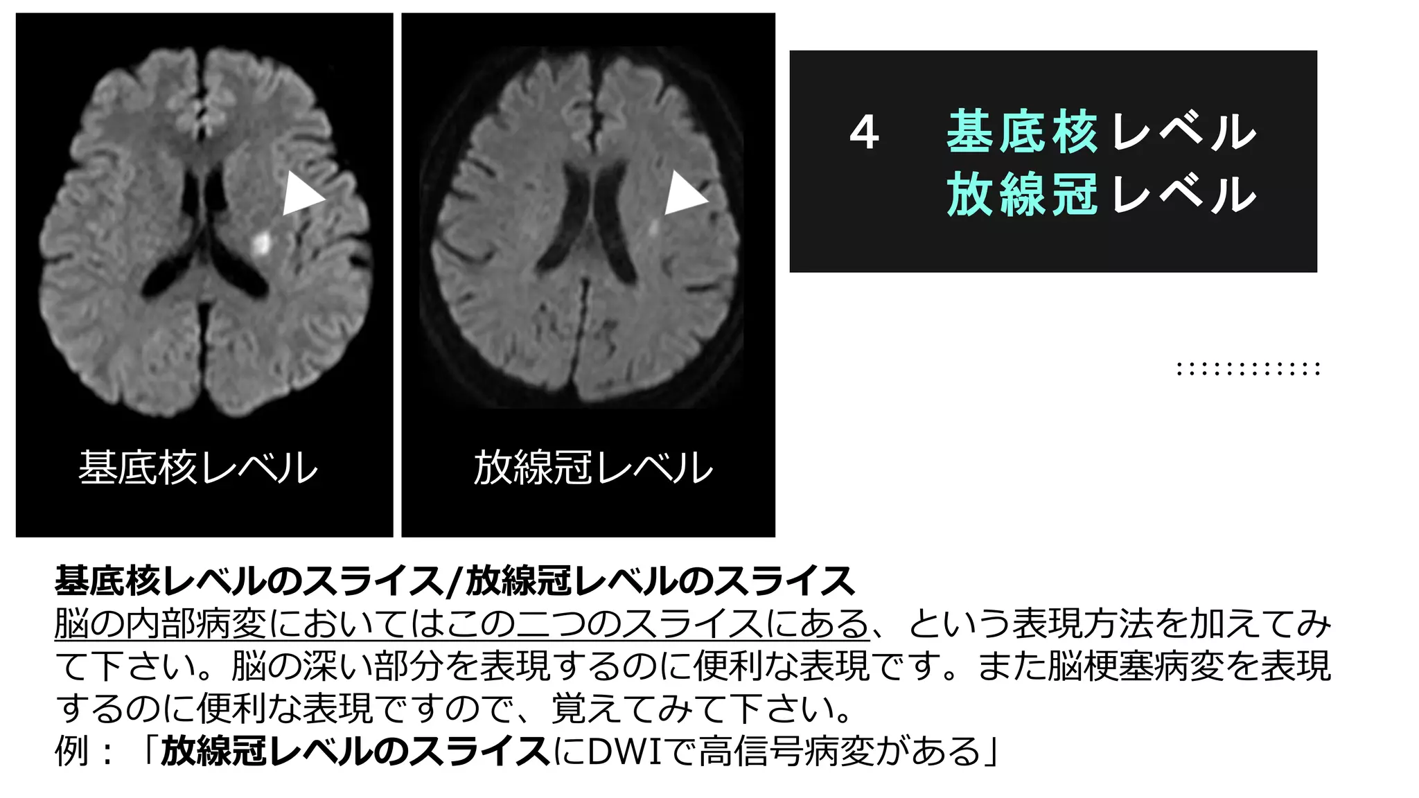 基底核レベルのスライス/放線冠レベルのスライス
脳の内部病変においてはこの二つのスライスにある、という表現方法を加えてみ
て下さい。脳の深い部分を表現するのに便利な表現です。また脳梗塞病変を表現
するのに便利な表現ですので、覚えてみて下さい。
例：「放線冠レベルのスライスにDWIで高信号病変がある」
４ 基底核レベル
放線冠レベル
基底核レベル 放線冠レベル
 