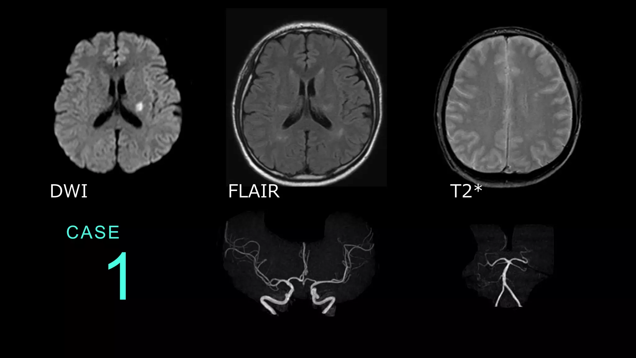 1
CASE
DWI FLAIR T2*
 