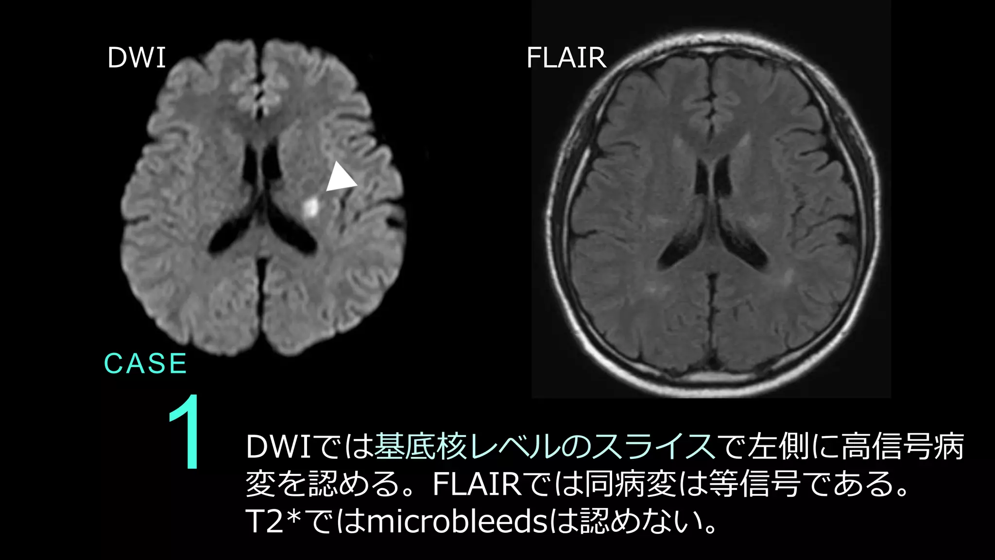 1
CASE
DWIでは基底核レベルのスライスで左側に高信号病
変を認める。FLAIRでは同病変は等信号である。
T2*ではmicrobleedsは認めない。
DWI FLAIR
 