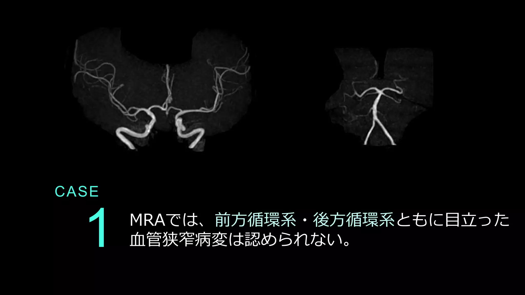 1
CASE
MRAでは、前方循環系・後方循環系ともに目立った
血管狭窄病変は認められない。
 