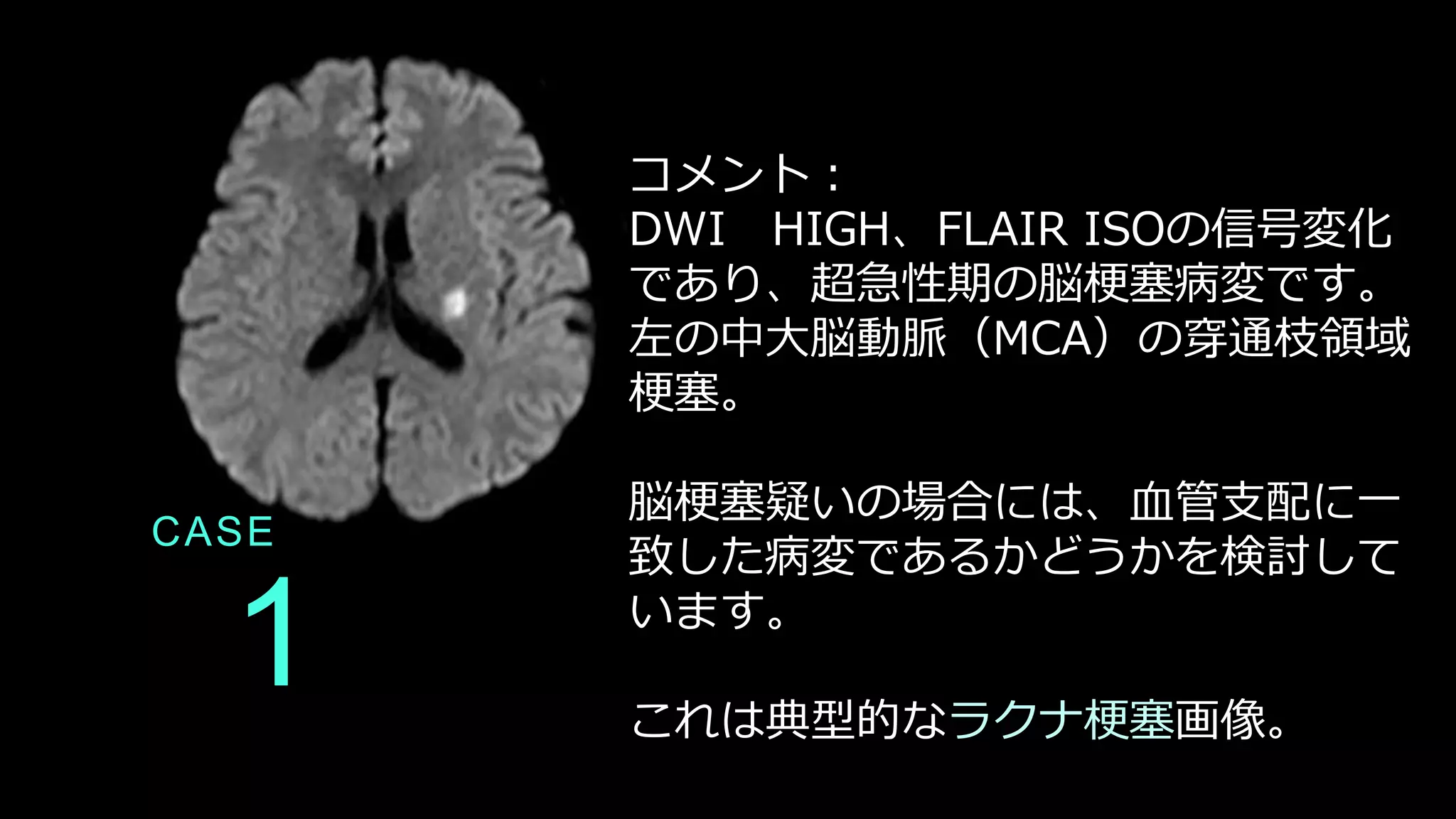 1
CASE
コメント：
DWI HIGH、FLAIR ISOの信号変化
であり、超急性期の脳梗塞病変です。
左の中大脳動脈（MCA）の穿通枝領域
梗塞。
脳梗塞疑いの場合には、血管支配に一
致した病変であるかどうかを検討して
います。
これは典型的なラクナ梗塞画像。
 