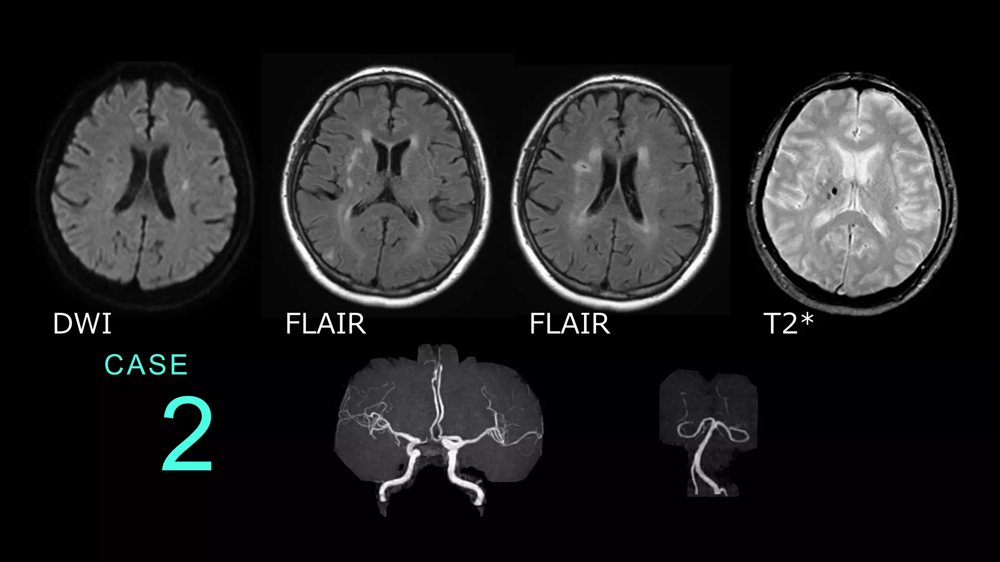 2
CASE
DWI FLAIR FLAIR T2*
 