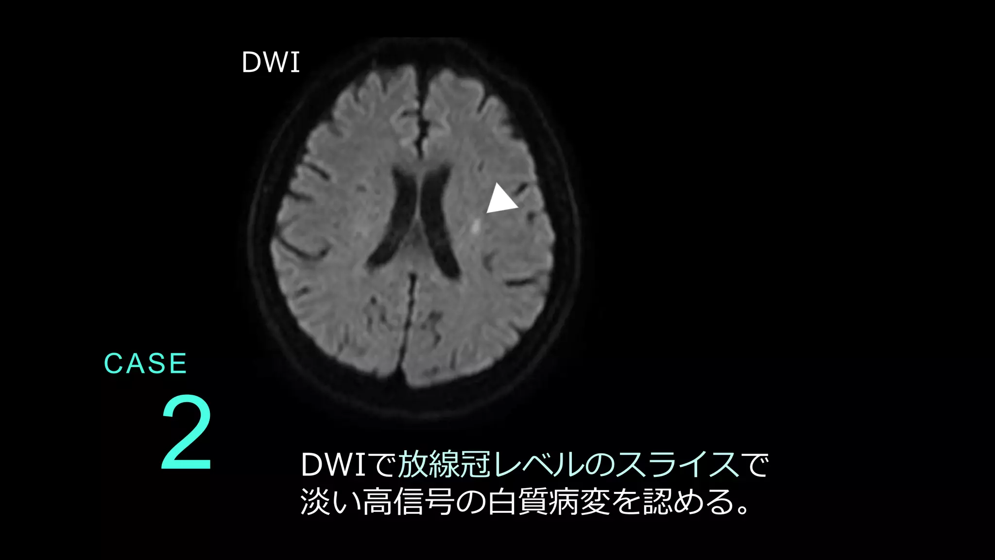 2
CASE
DWIで放線冠レベルのスライスで
淡い高信号の白質病変を認める。
DWI
 