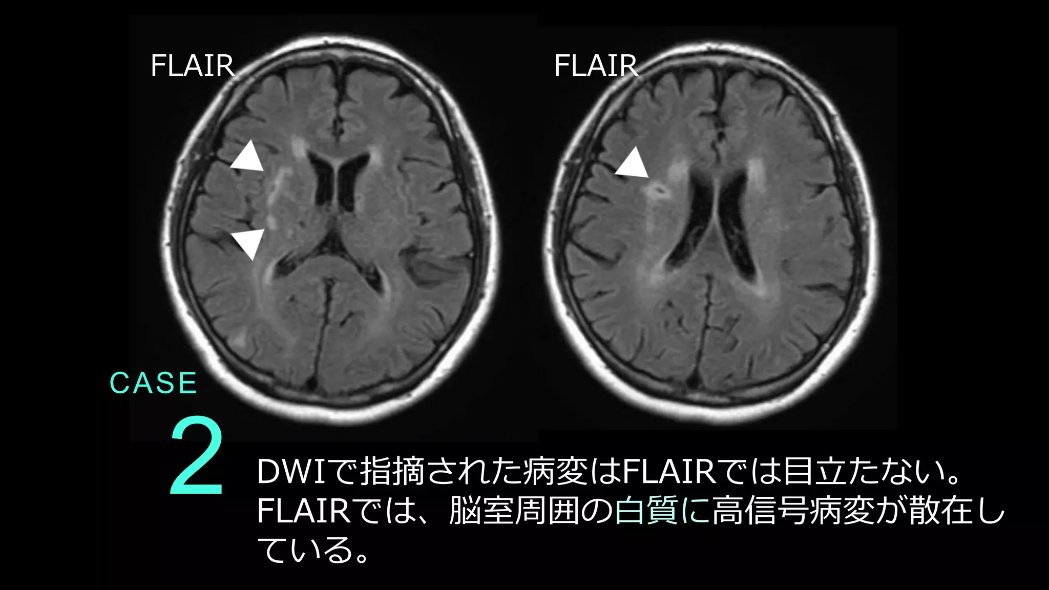CASE
2 DWIで指摘された病変はFLAIRでは目立たない。
FLAIRでは、脳室周囲の白質に高信号病変が散在し
ている。
FLAIR FLAIR
 