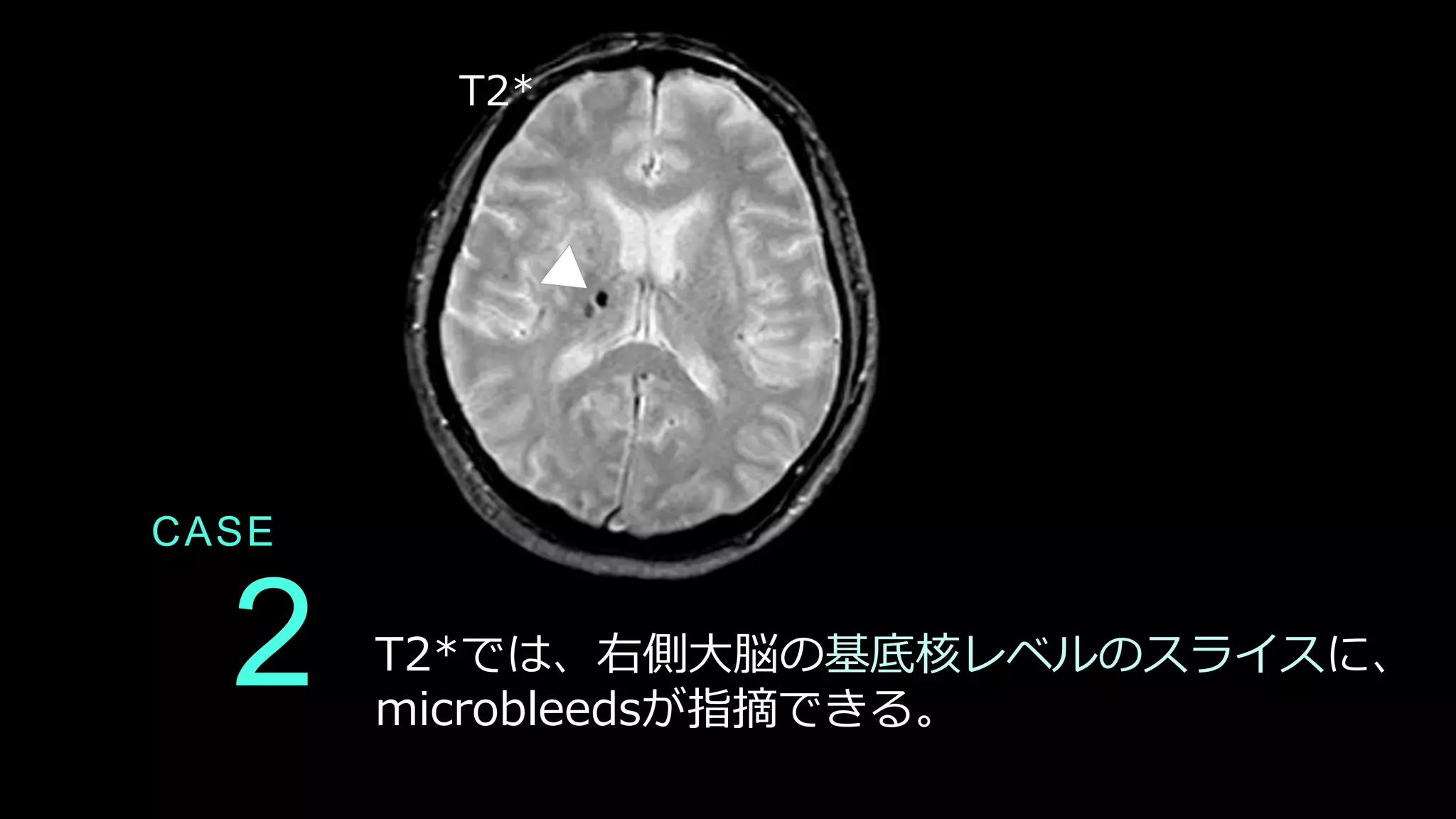 2
CASE
T2*では、右側大脳の基底核レベルのスライスに、
microbleedsが指摘できる。
T2*
 