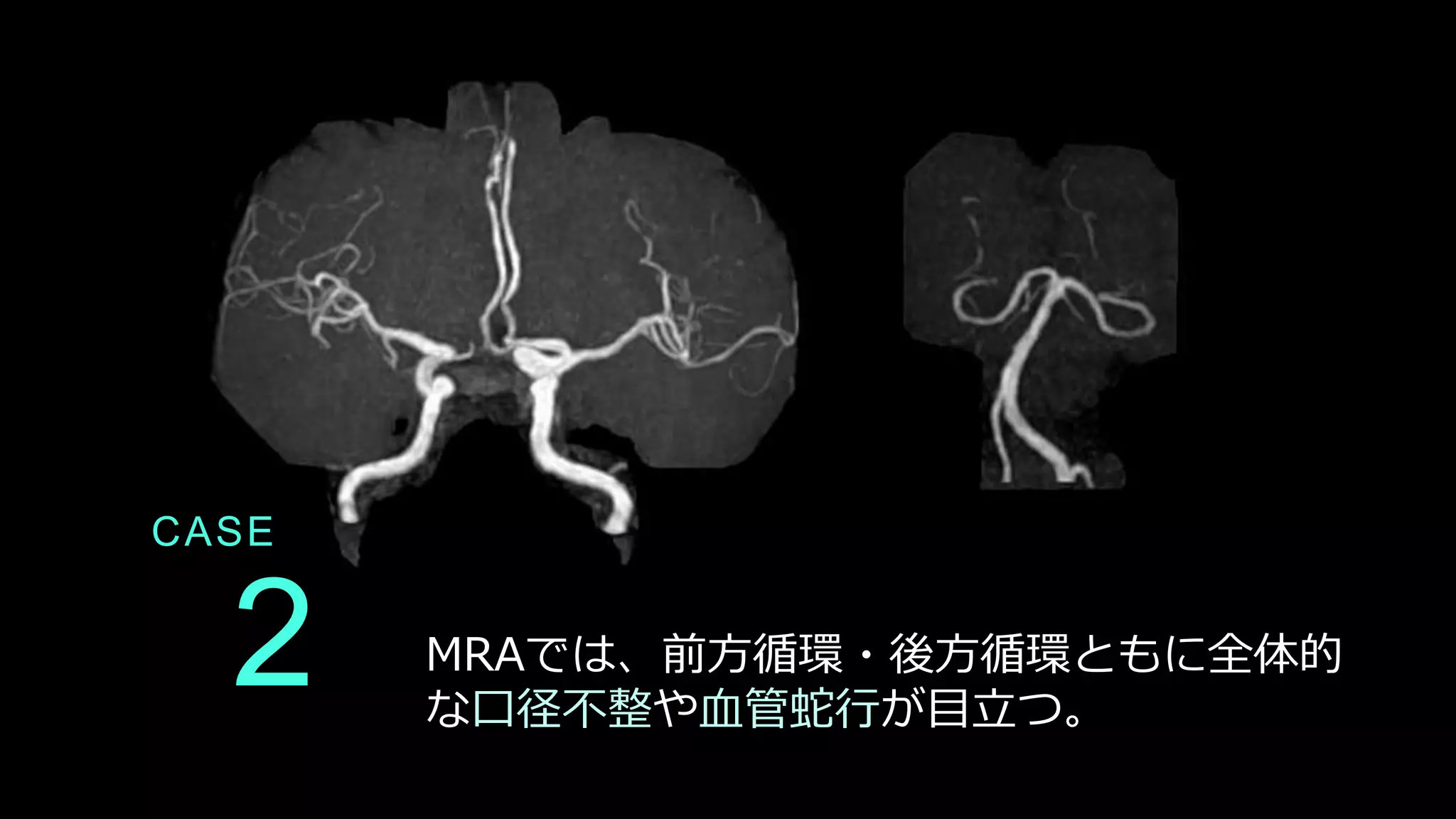 CASE
2 MRAでは、前方循環・後方循環ともに全体的
な口径不整や血管蛇行が目立つ。
 