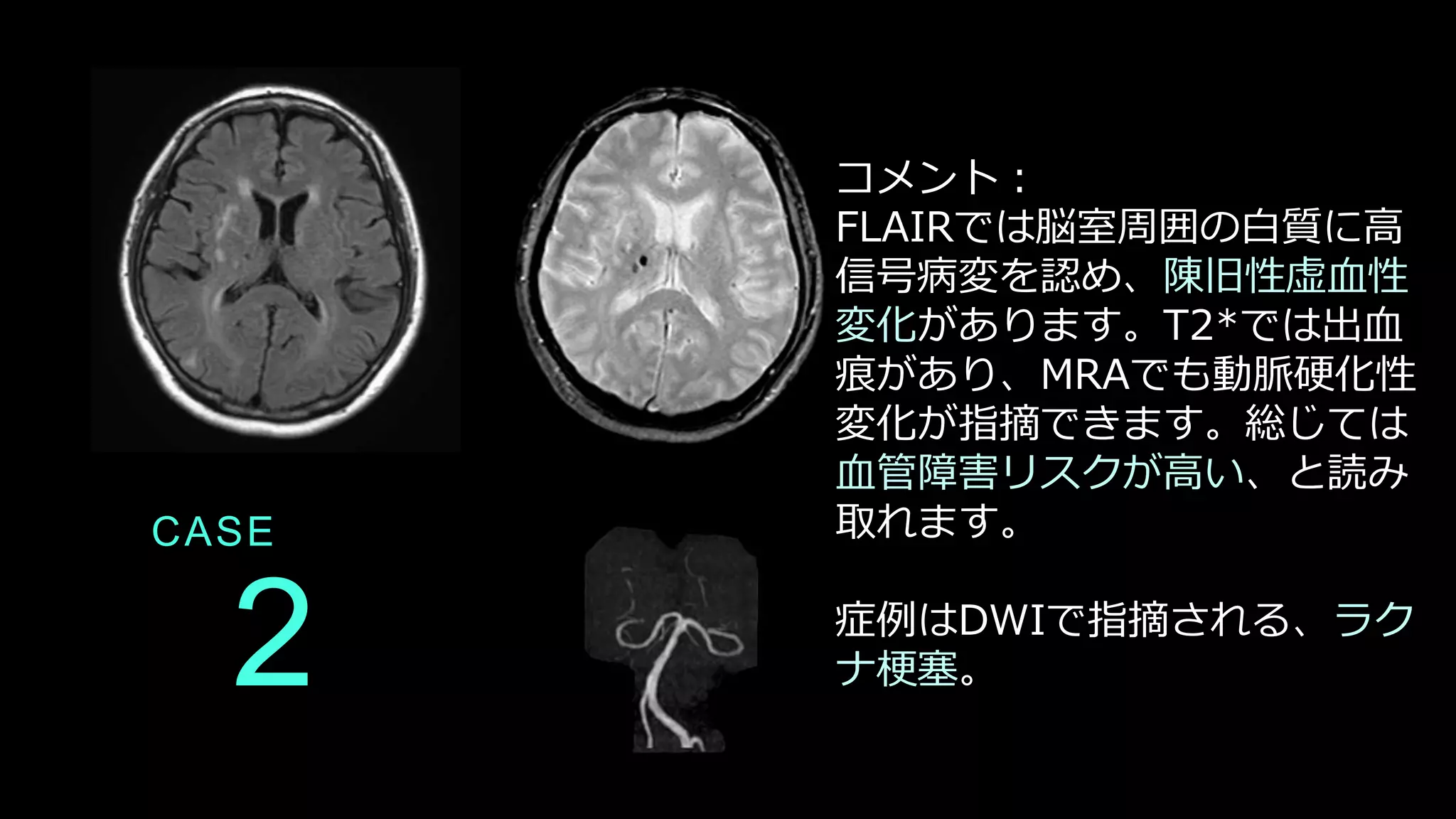 2
CASE
コメント：
FLAIRでは脳室周囲の白質に高
信号病変を認め、陳旧性虚血性
変化があります。T2*では出血
痕があり、MRAでも動脈硬化性
変化が指摘できます。総じては
血管障害リスクが高い、と読み
取れます。
症例はDWIで指摘される、ラク
ナ梗塞。
 