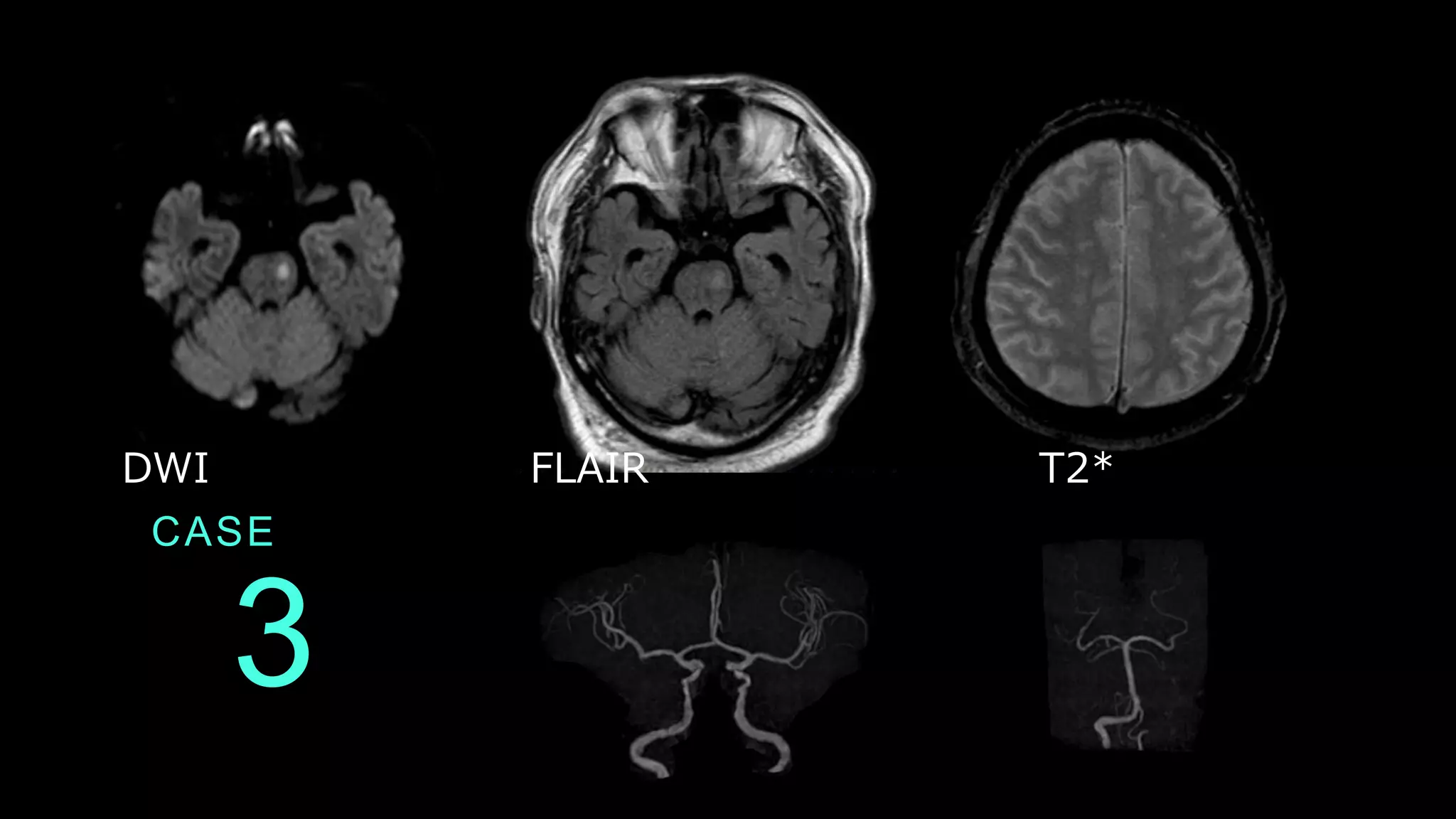 CASE
3
DWI FLAIR T2*
 