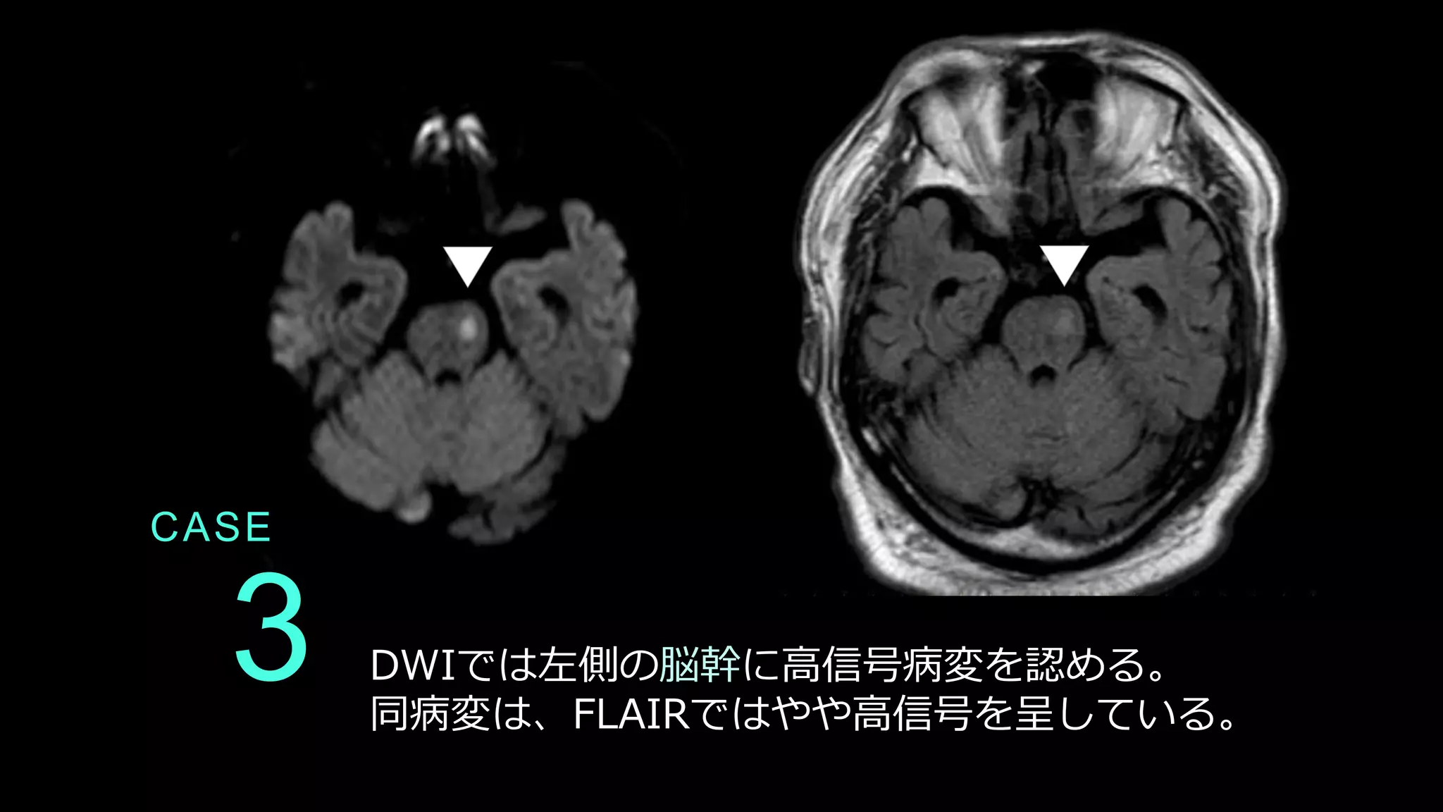 CASE
3 DWIでは左側の脳幹に高信号病変を認める。
同病変は、FLAIRではやや高信号を呈している。
 