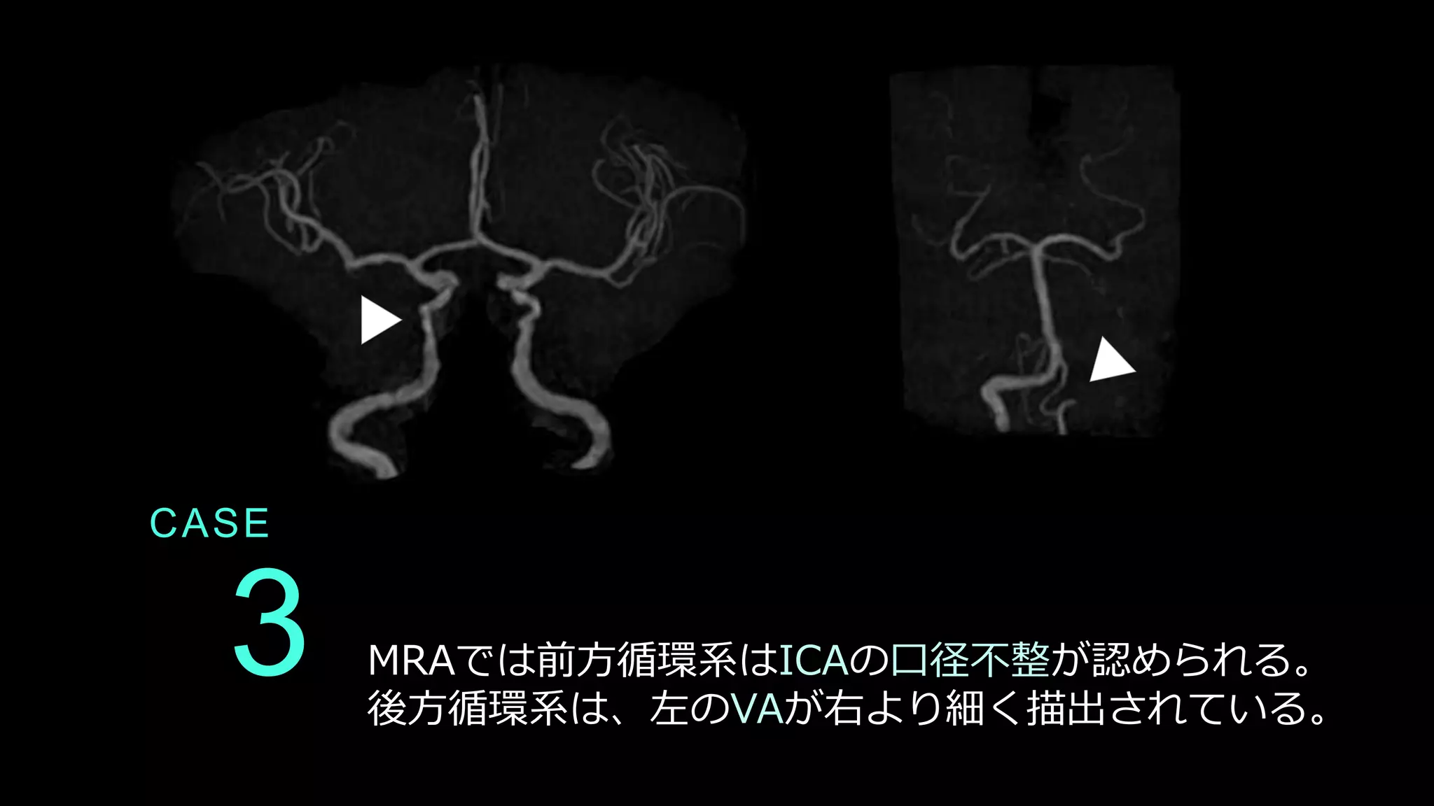 CASE
3 MRAでは前方循環系はICAの口径不整が認められる。
後方循環系は、左のVAが右より細く描出されている。
 