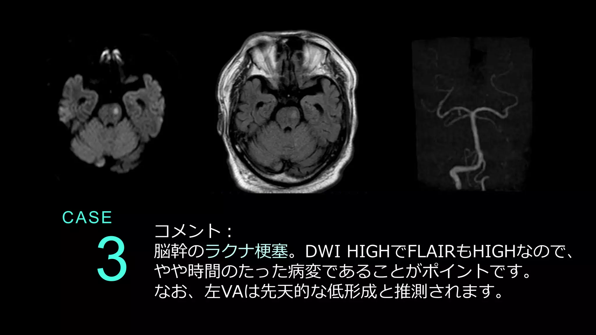 CASE
3
コメント：
脳幹のラクナ梗塞。DWI HIGHでFLAIRもHIGHなので、
やや時間のたった病変であることがポイントです。
なお、左VAは先天的な低形成と推測されます。
 