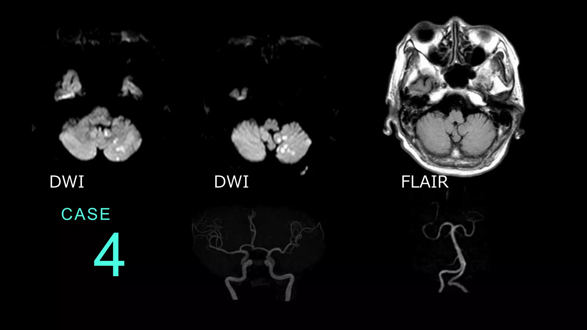 CASE
4
DWI DWI FLAIR
 