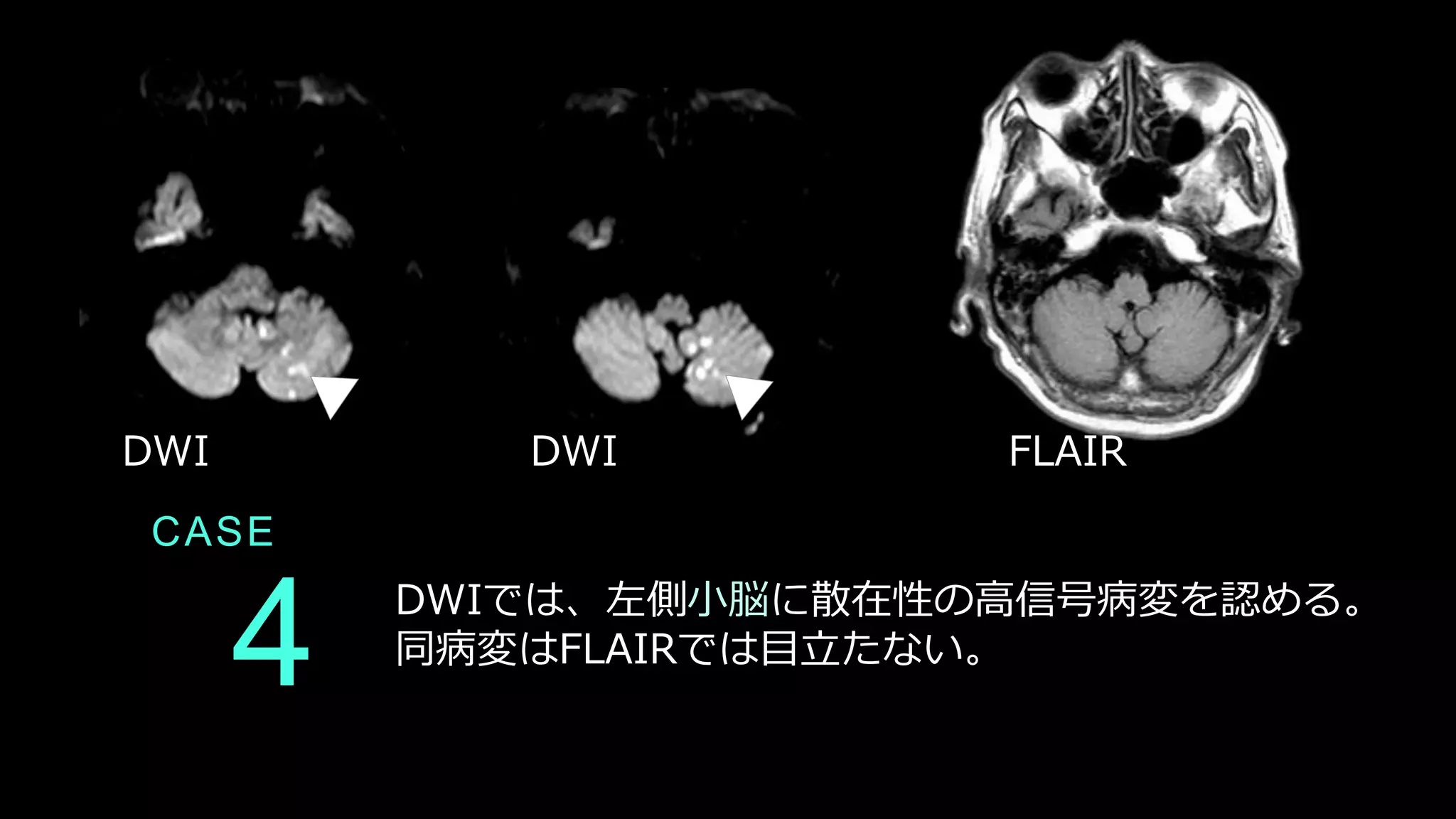 CASE
4 DWIでは、左側小脳に散在性の高信号病変を認める。
同病変はFLAIRでは目立たない。
DWI DWI FLAIR
 