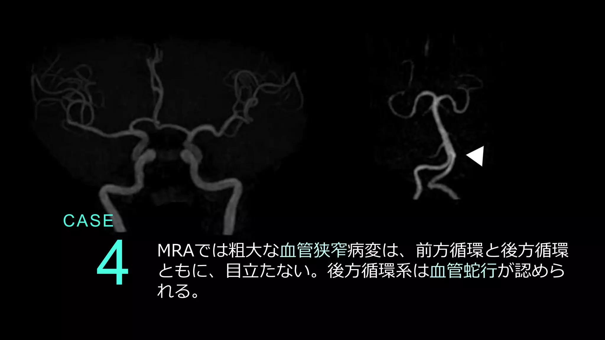 CASE
4 MRAでは粗大な血管狭窄病変は、前方循環と後方循環
ともに、目立たない。後方循環系は血管蛇行が認めら
れる。
 