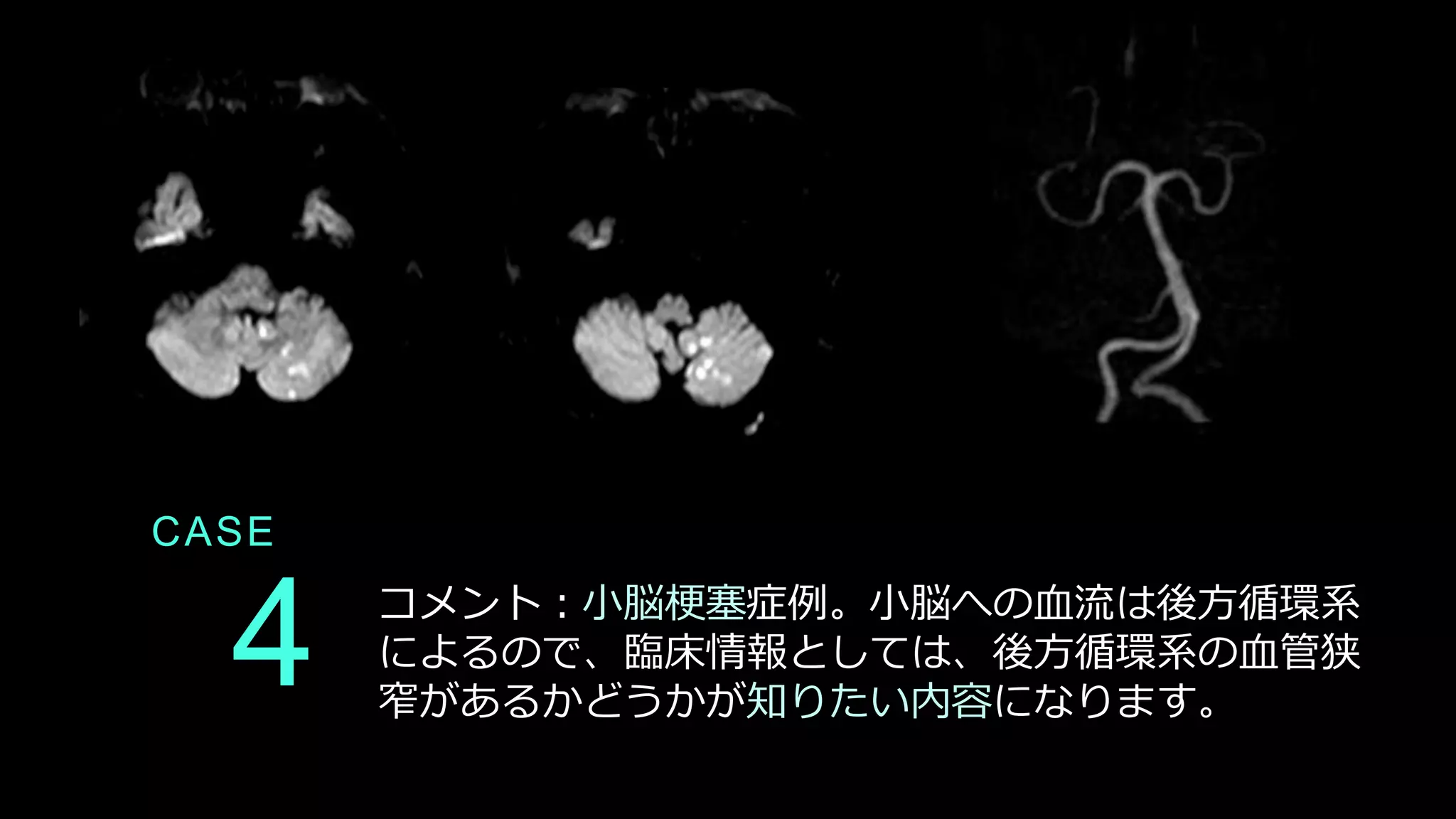 CASE
4 コメント：小脳梗塞症例。小脳への血流は後方循環系
によるので、臨床情報としては、後方循環系の血管狭
窄があるかどうかが知りたい内容になります。
 