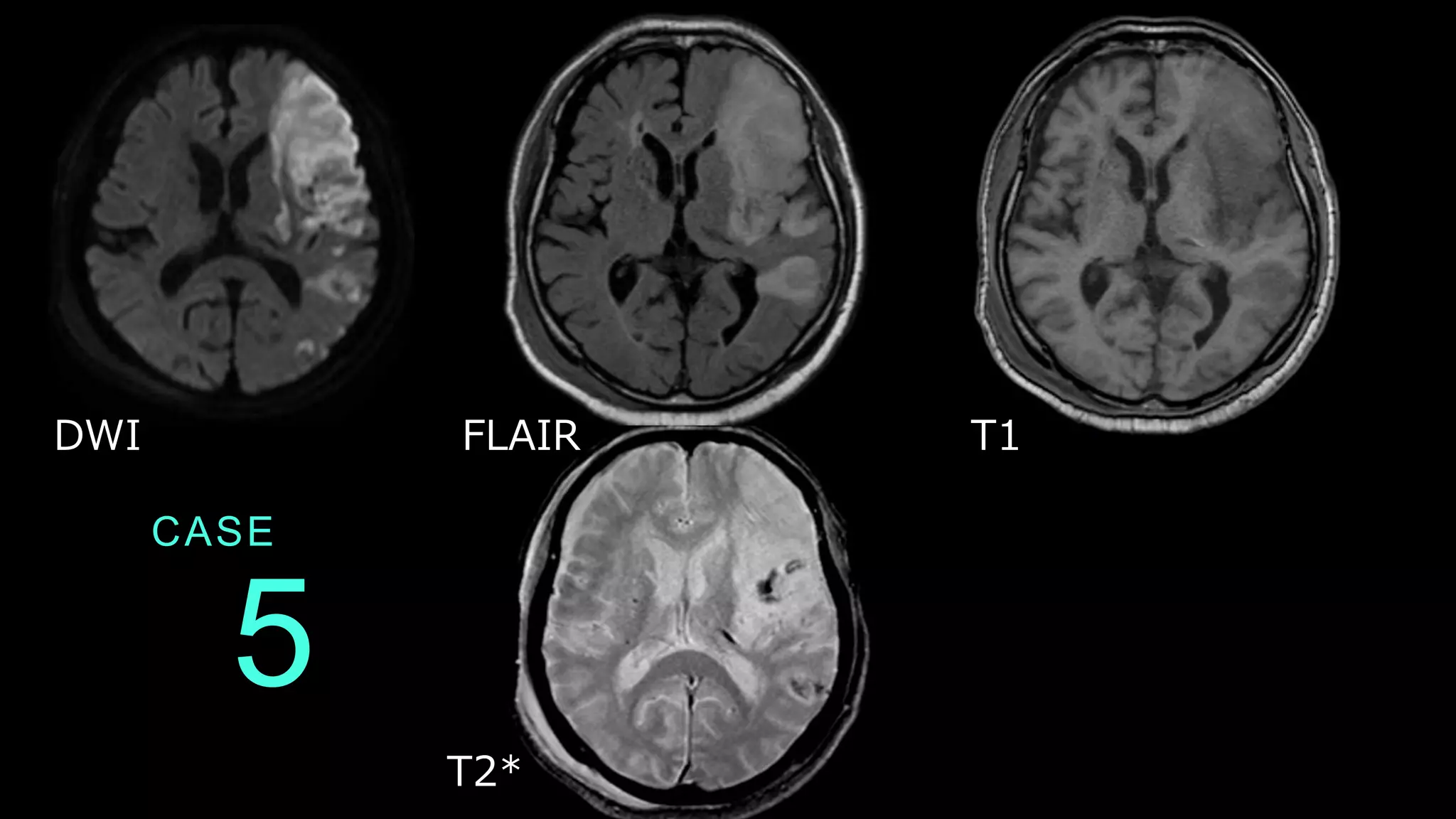 CASE
5
DWI FLAIR T1
T2*
 