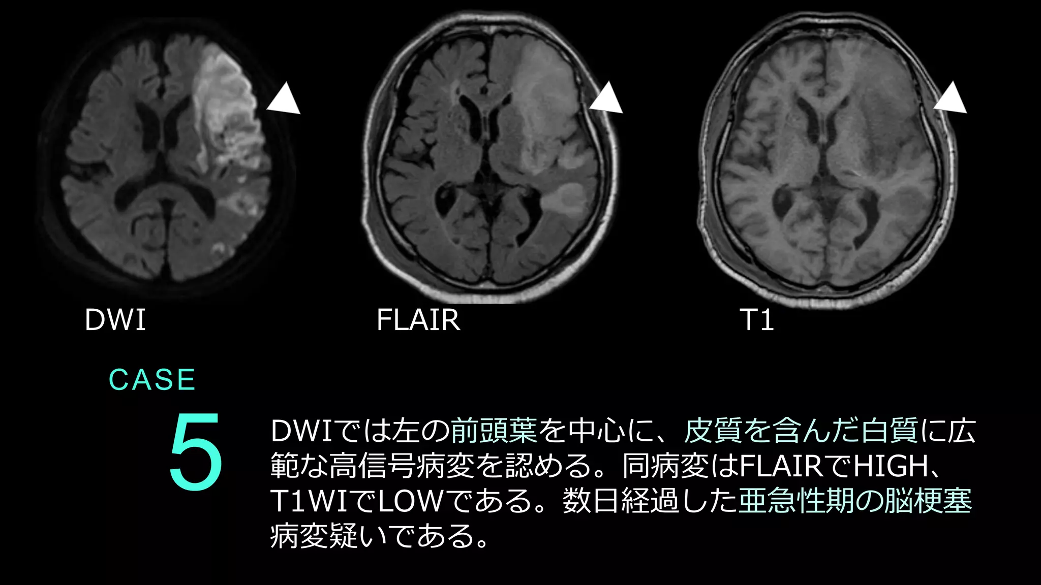CASE
5 DWIでは左の前頭葉を中心に、皮質を含んだ白質に広
範な高信号病変を認める。同病変はFLAIRでHIGH、
T1WIでLOWである。数日経過した亜急性期の脳梗塞
病変疑いである。
DWI FLAIR T1
 